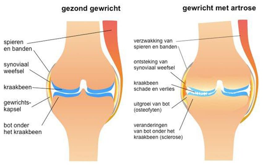 Osteo-arthritis